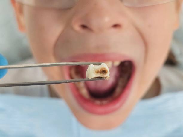 Best Emergency Treatment for Dental Infections or Abscesses in Lafayette, OR